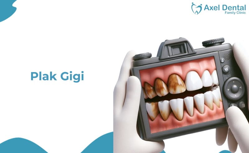 Plak Gigi: Penyebab & Cara Menghilangkannya