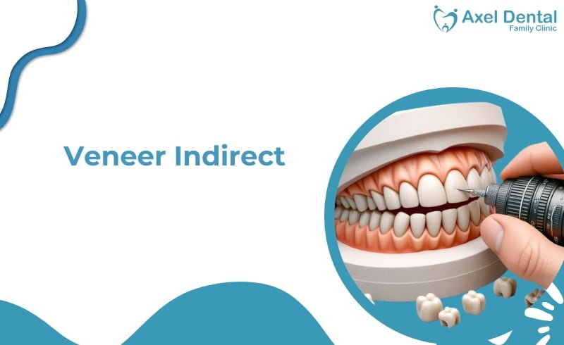 Veneer Indirect: Definisi, Harga, Manfaat dan Kelebihannya