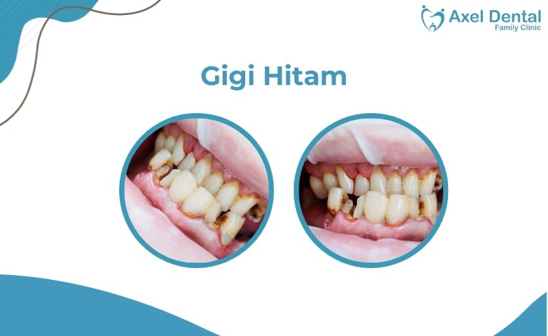 Gigi Hitam: Penyebab, Gejala dan Cara Mengatasinya