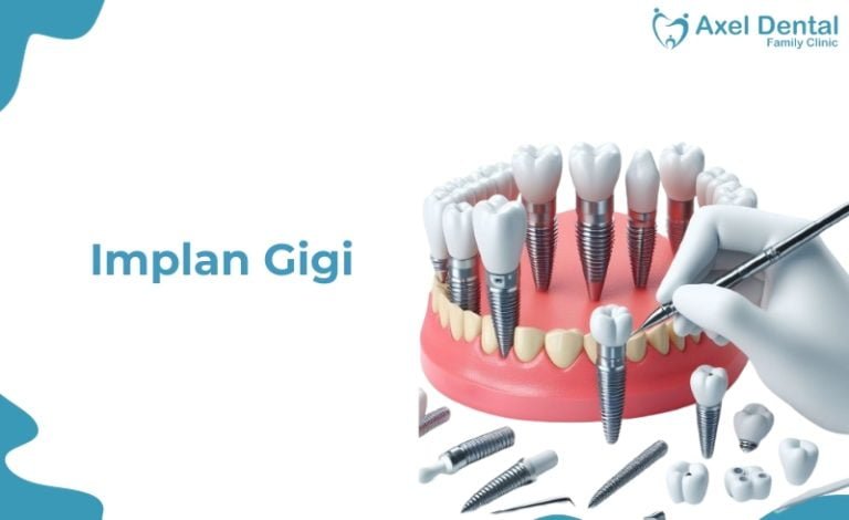 Pemasangan implan gigi