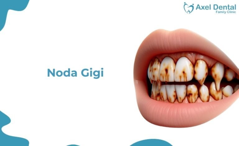 Noda Coklat pada Gigi