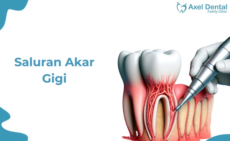 Saluran Akar Gigi: Masalah & Cara Mengatasinya