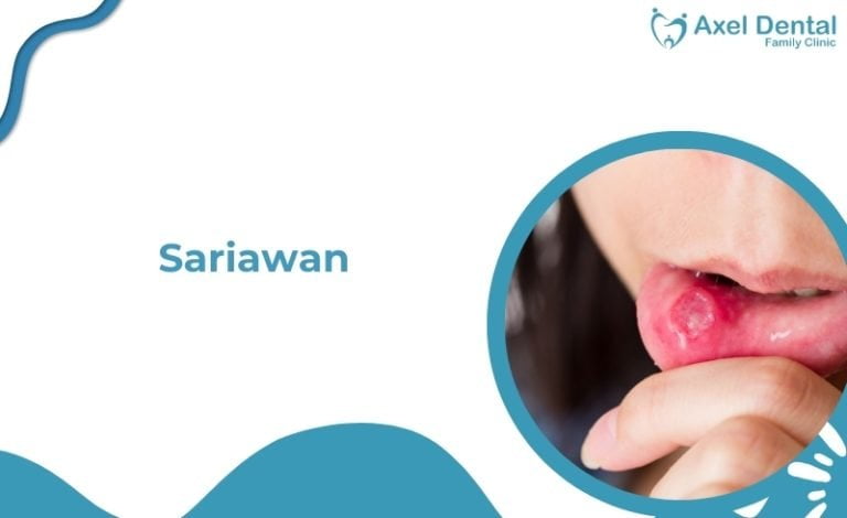 sariawan di bibir