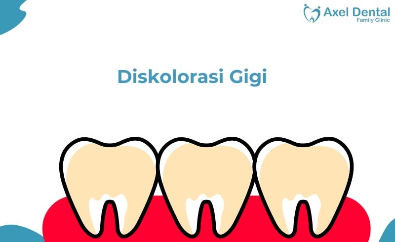 Diskolorasi Gigi: Definisi, Jenis, Bahaya dan Pencegahannya