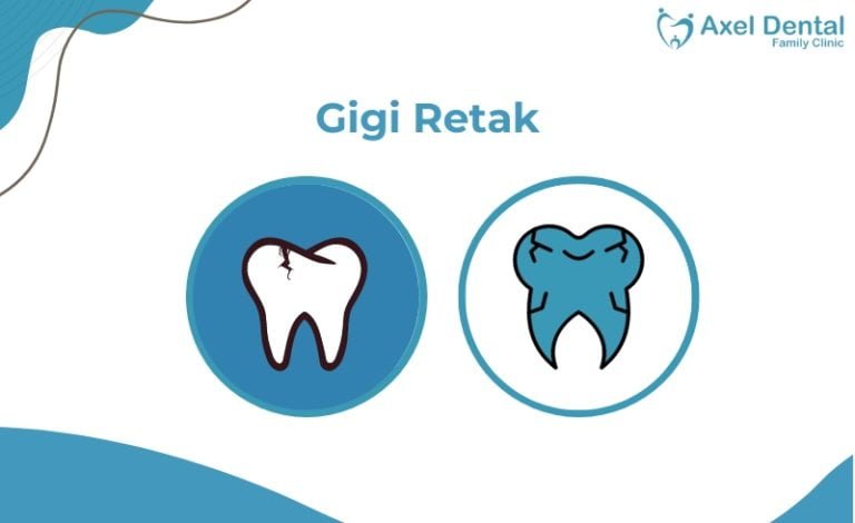 Gigi Retak