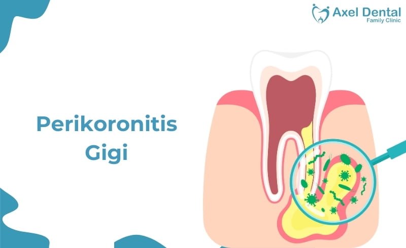 Perikoronitis Gigi: Penyebab dan Cara Mengatasinya