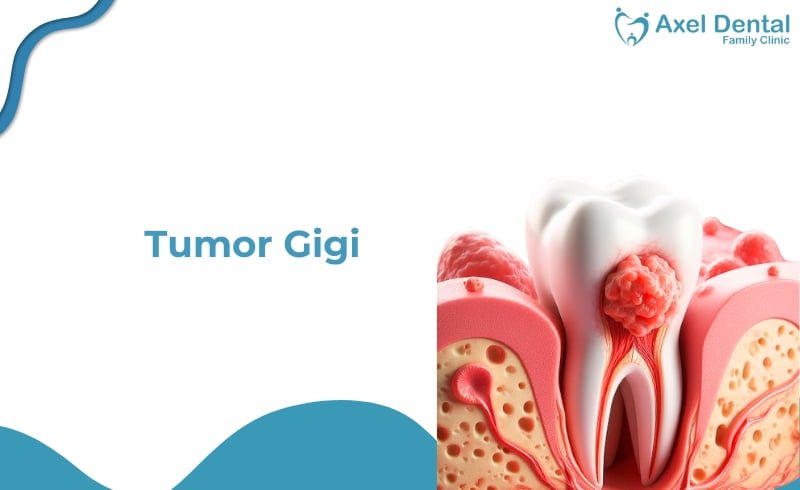 Tumor Gigi, Serem! Kenali dan Waspadai Yuk!