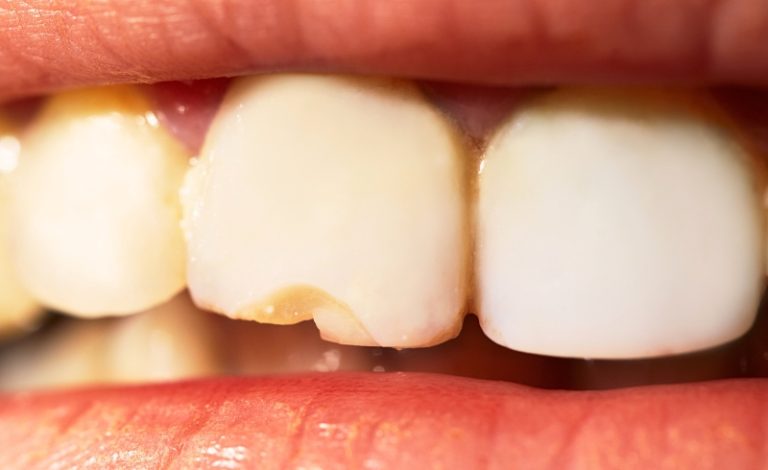 Close-up mulut tersenyum seseorang yang menunjukkan kerusakan pada crown gigi logam, kemungkinan crown gigi patah