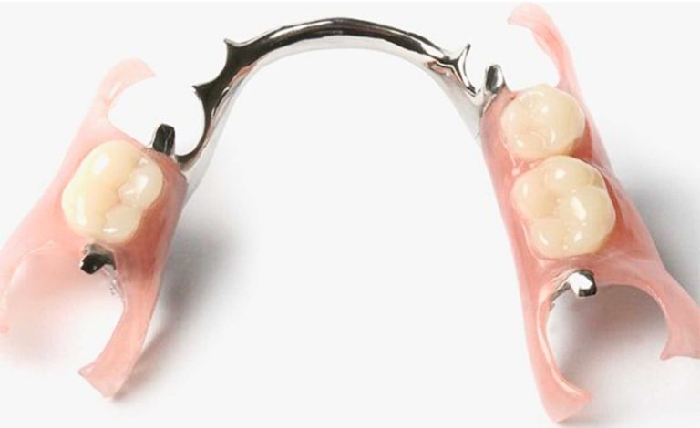 Gigi palsu lepasan dengan kerangka berbahan logam