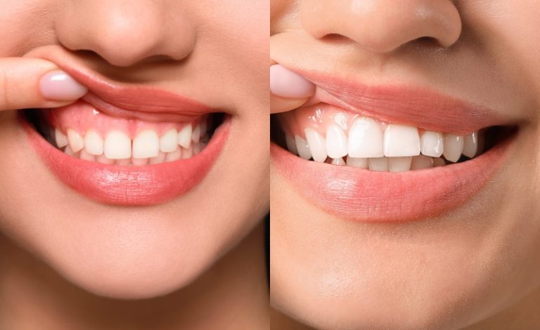 Illustrasi wanita sebelum potong gusi dan sesudah potong gusi