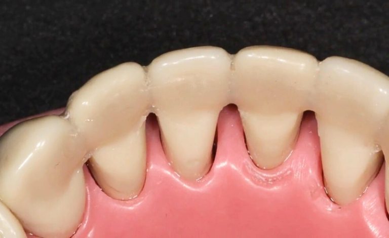 Close-up gigi seseorang dengan belat gigi bening yang direkatkan pada enam gigi atas depan. Belat tersebut tipis dan melapisi sebagian email pada tiap gigi. Biaya splinting gigi bervariasi tergantung pada jenis belat, lokasi klinik, dan pengalaman dokter gigi