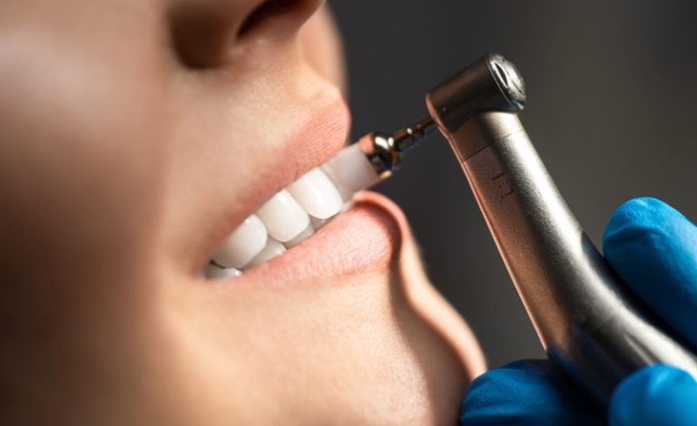 Wanita menjalani prosedur scaling gigi untuk membersihkan karang gigi.