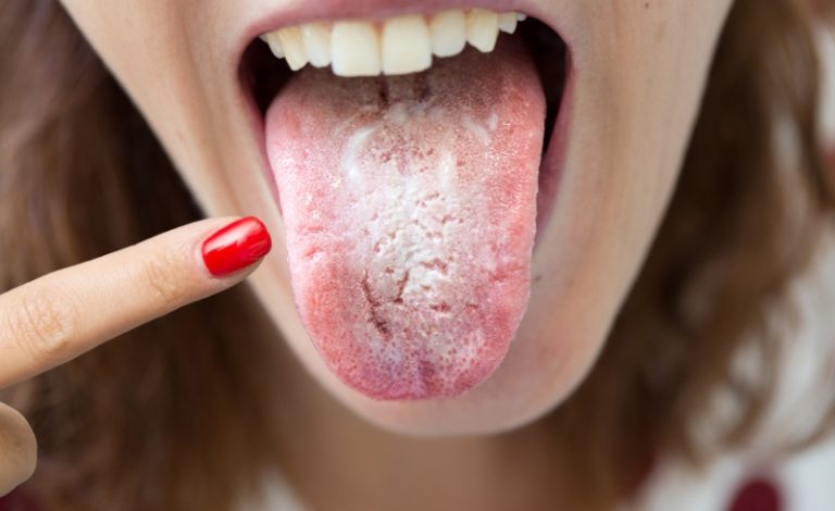 Bercak putih merupakan salah satu penyakit lidah