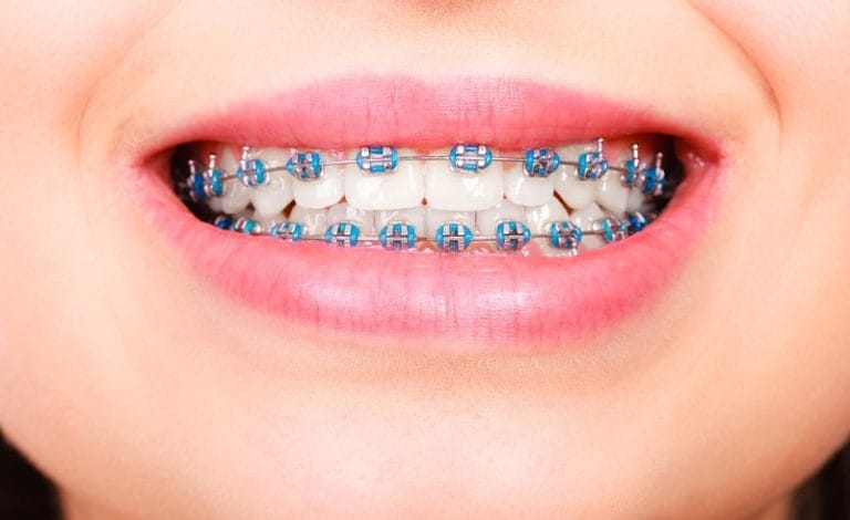 Karet behel berwarna biru pada gigi wanita