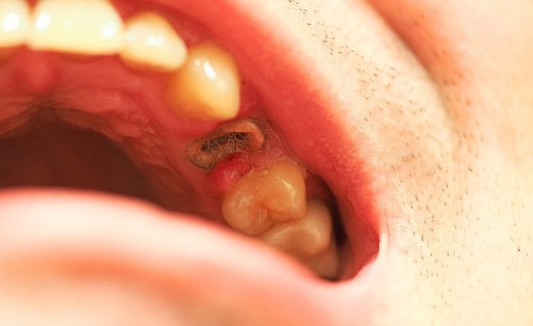 Seorang Pria Memiliki Gigi Berlubang di Gigi Atas