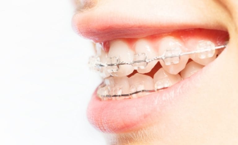seorang wanita menggunakan behel gigi keramik